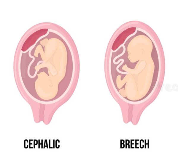 Optimal Fetal Positioning – How2Mom | Birth Support, Online Birthing ...